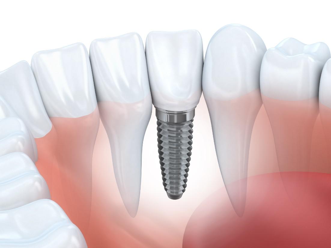 Dental Implants Crystal, MN
