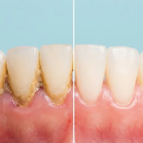 before and after scaling and root planing periodontics