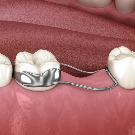 Space maintainers gently hold space for permanent teeth, preventing crowding and protecting their future smile.