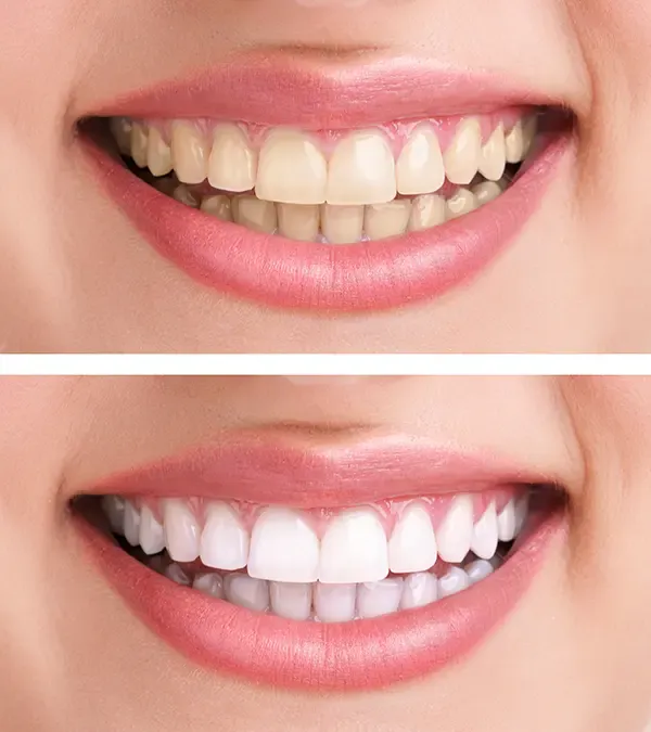 Teeth Whitening Crystal MN